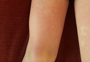 Typical "lacy" rash of Fifth Disease